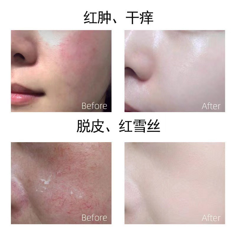 高效修复膏去红血丝激素脸修复敏感肌增厚角质层退红修复霜角质层|undefined