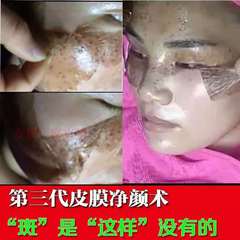 Five-day beauty salon spot removal and skin brightening spot treatment, peel-off mask for removing dark spots and blackheads