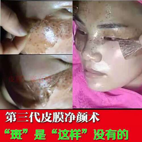 Five-day beauty salon spot removal and skin brightening spot treatment, peel-off mask for removing dark spots and blackheads