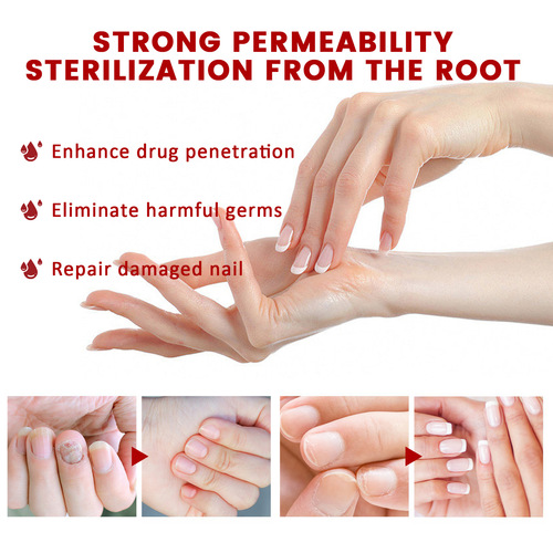 West&Month Onychomycosis Repair Solution, Hand and Foot Brightening Nails, Soft Nails, Rotten Toenails, Thickening, Nourishing Nails, Moisturizing Manicure