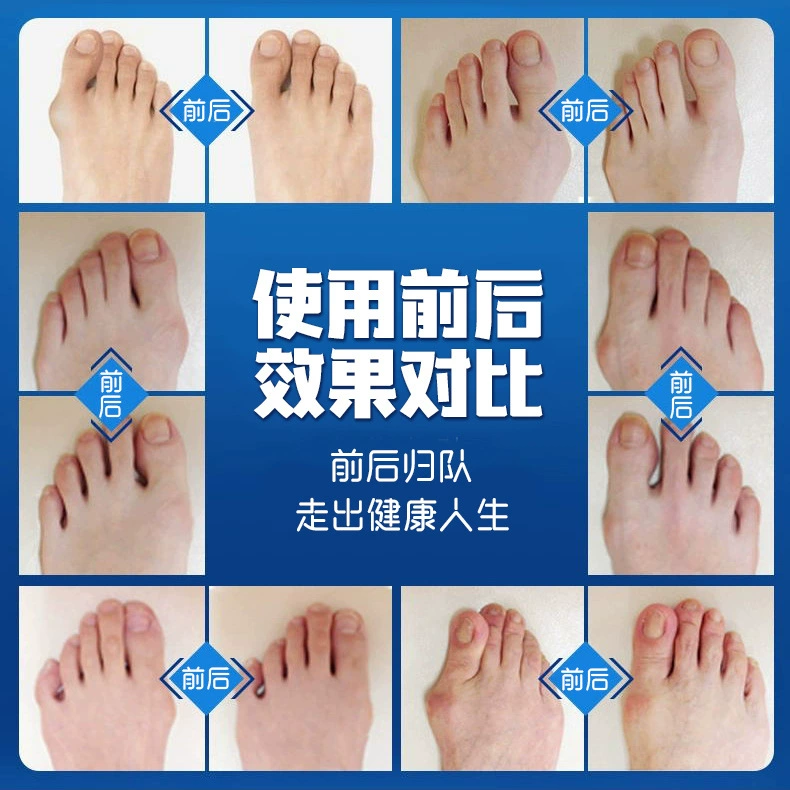 New toe improver thumb valgus split toe big foot bone free adjustment bend separation improver