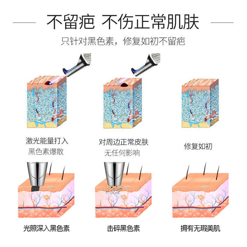 手に持っています。ピコ秒のペンレーザーで眉を洗います。|undefined