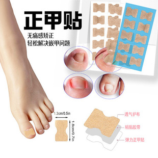 Toenail Correction Sticker Nail Sticker Toenail Groove Inlay Nail Glue-Free Foot Lala Sticker Self-Adhesive Correction Nail Sticker