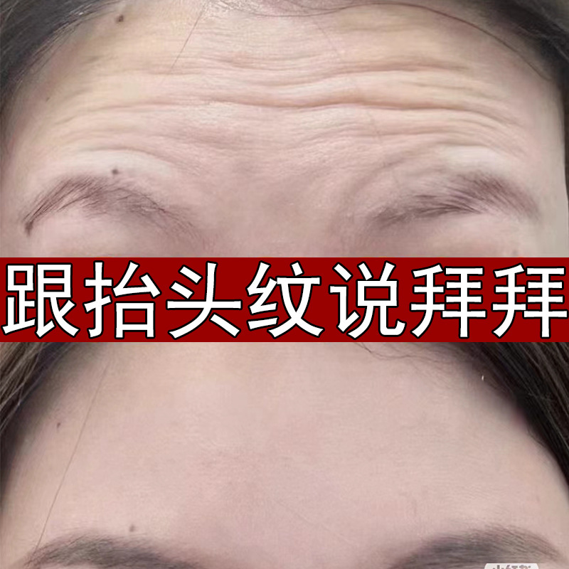 コラーゲン充填粉は法令紋に行きます。小紋を充填します。|undefined