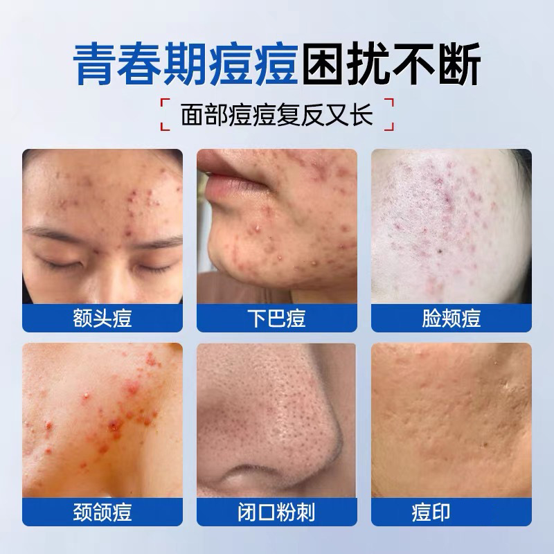 ハーブニキビクリームメーカー、ニキビ跡を薄くし、ニキビを取り除き、ニキビを閉じ、鎮静し、修復し、美容室のニキビクリーム|undefined