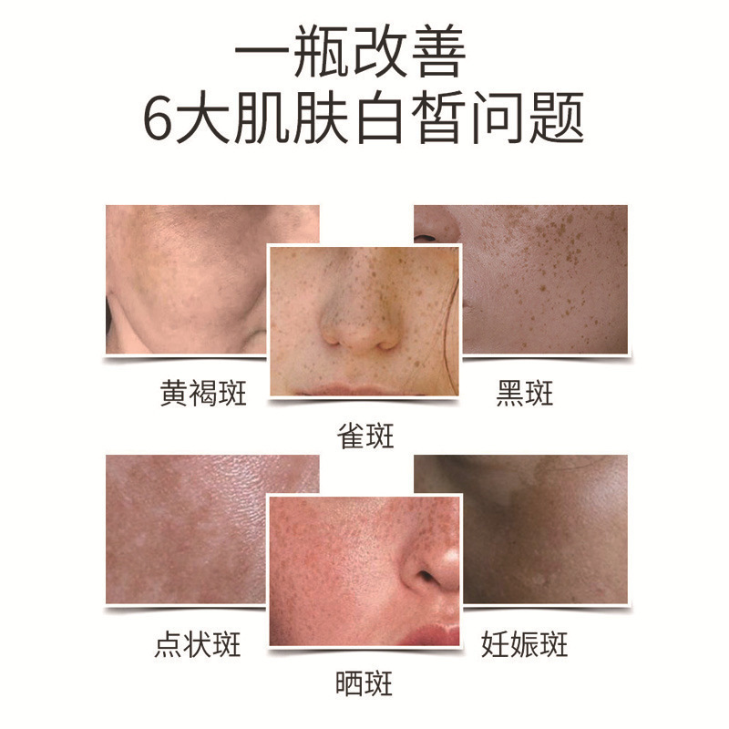 美白はシミを取り除いて黄のシミのそばかすを取り除きます。|undefined
