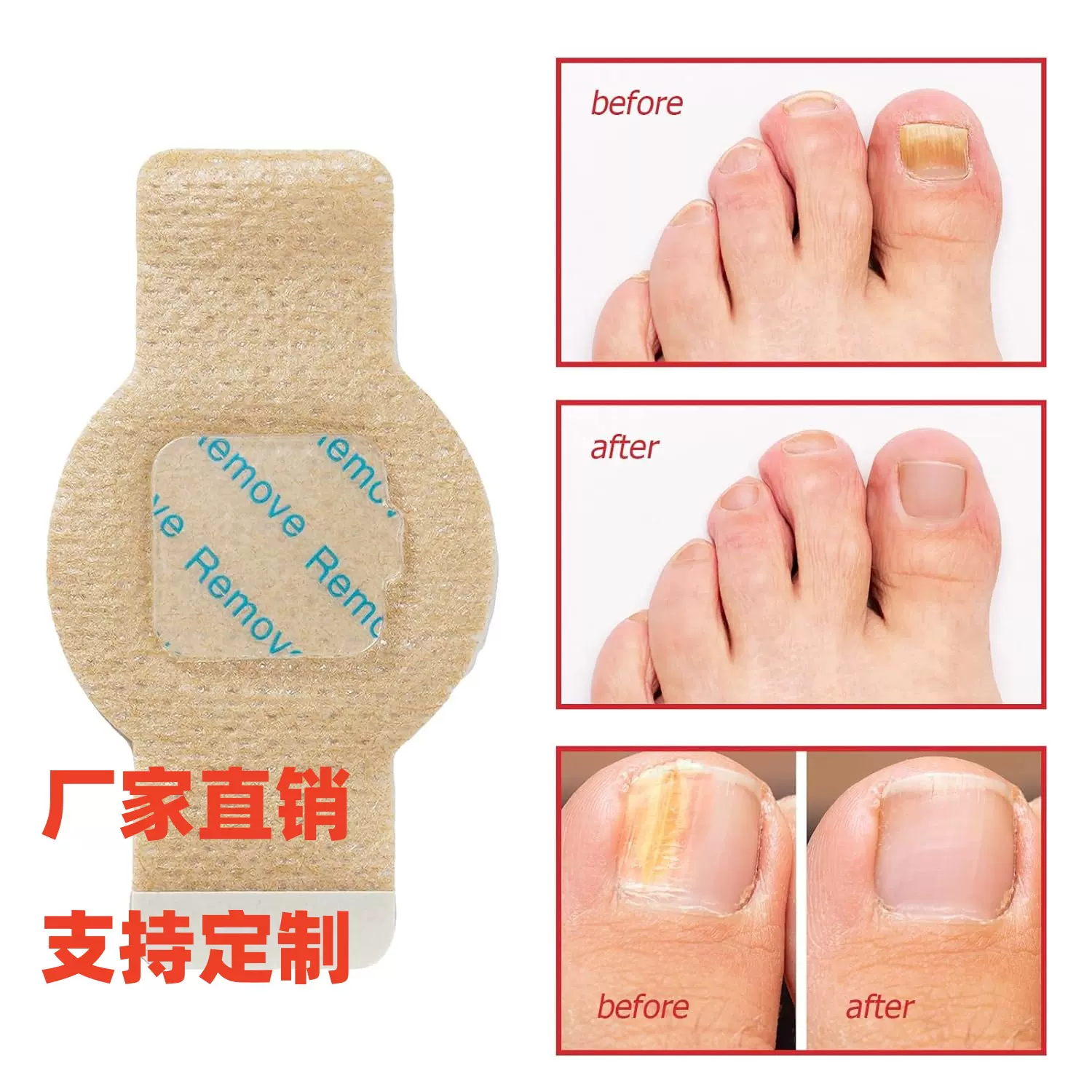 跨境指甲指甲修护矫正贴修复灰指甲足部护理甲沟发炎护甲贴抑菌贴