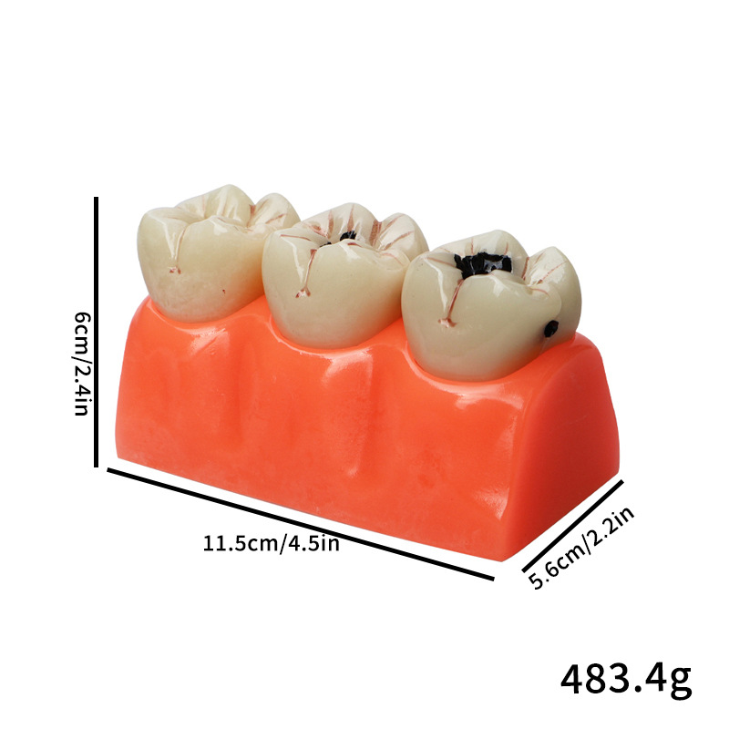 Descomposición de caries dental modelo anatomía modelo dientes cuidado dental caries dental