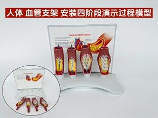 Cardiovascular and cerebrovascular blockage model joint thrombosis blood concentration fat pathology atherosclerosis human anatomy teaching aids