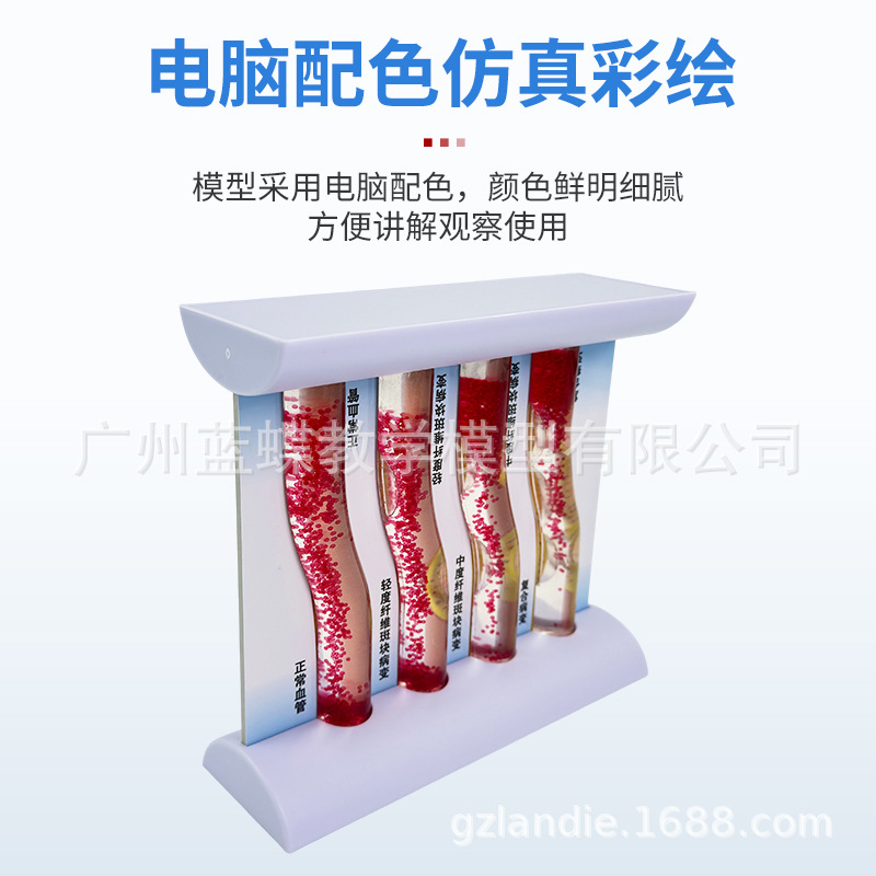 Ѫ�ܷ������Ѫ֬��Ѫ֬ģ�Ͳ�����̬Ӳ������Ѫ˨ֱ�۽�ѧ����