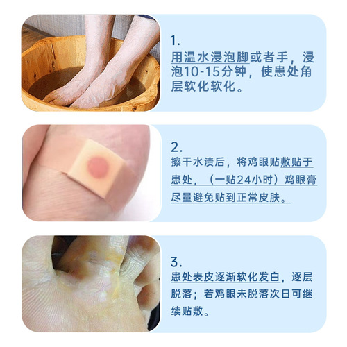 Nanjing Tongrentang Lejia Old Shop Corns Patch Corns Ointment Flesh Pricks Calluses Foot Care Corns Plaster