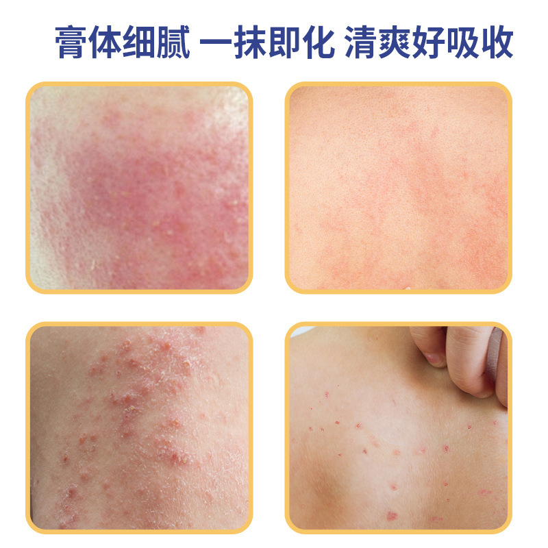 新品抖音同款香港大药房狼毒癣清膏 外用皮肤乳膏草本膏药50g|undefined