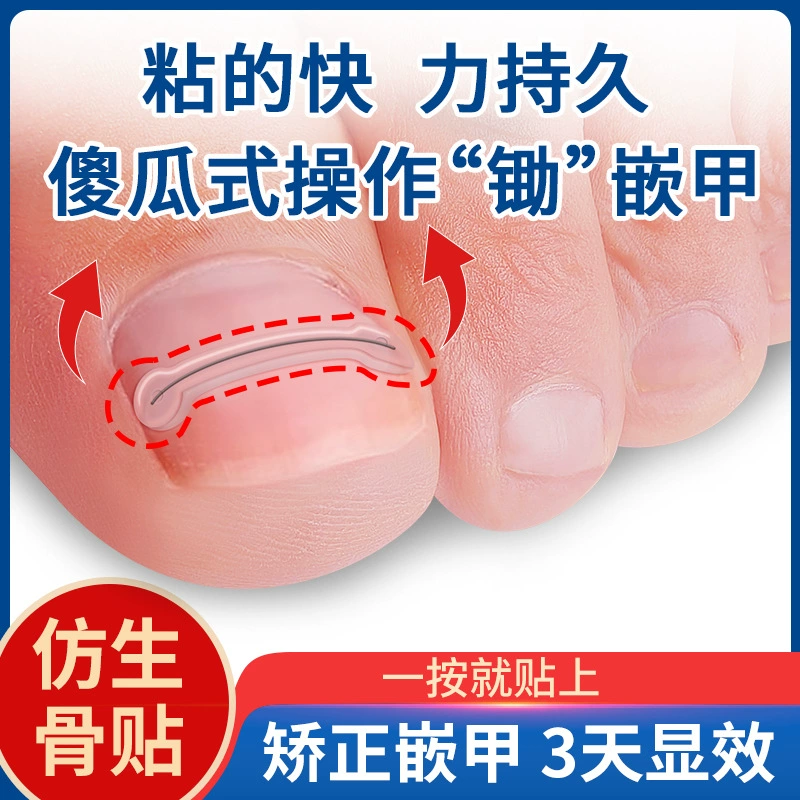 Arcanium-инкрустированная стальная проволока из никель-титанового сплава бионическая кость пластырь пластырь пластырь