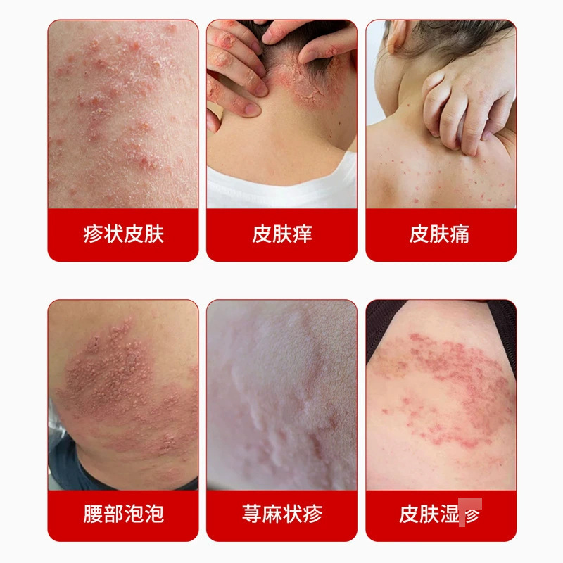 タイ麻アレルギーかゆみ止め特別な全身かゆみ止めハーブ皮膚湿ったかゆみ赤疹ヘルスケア クリーム メーカー|undefined