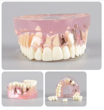 Modelo de ortodoncia dental semi-metal semibrackets Práctica de corrección de molde dental estándar Comunicación médico-paciente Modelo de enseñanza Modelo dental