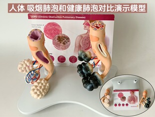 Tracheal smoking lung and healthy alveolar model large alveolar amplification human visceral respiratory lung teaching model