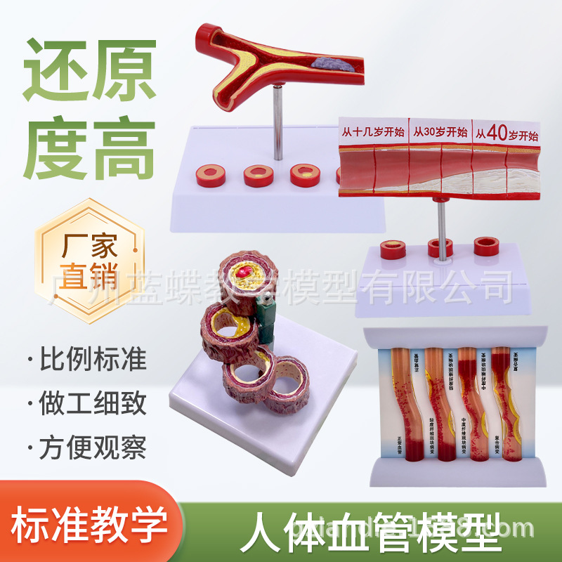 Ѫ�ܷ������Ѫ֬��Ѫ֬ģ�Ͳ�����̬Ӳ������Ѫ˨ֱ�۽�ѧ����