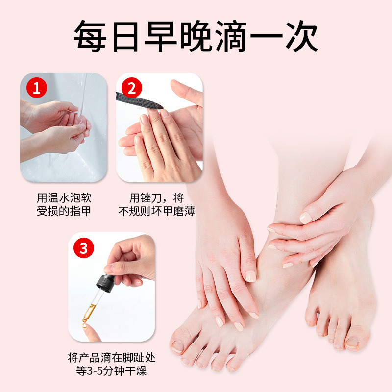 爪真菌症ソリューションフットケアソリューション爪真菌症健康ソリューション肥厚明るい爪真菌症ネットソフト爪クリーム爪真菌症ソリューション卸売|undefined