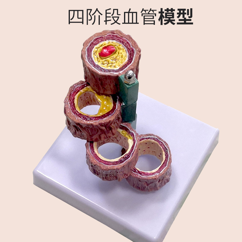 Modelo de la arteria coronaria Modelo de la arteria cardiovascular modelo de endurecimiento