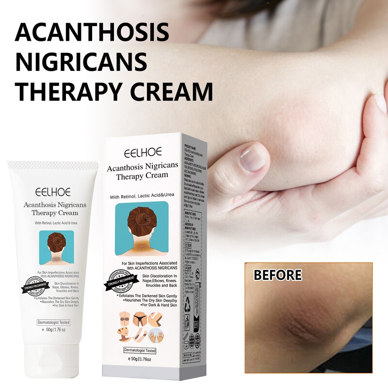 Eelhoe Black Thorn Skin Care Cream Moisturizes and Softens Arms and Knees, Refreshing and Comfortable Skin Care for the Body