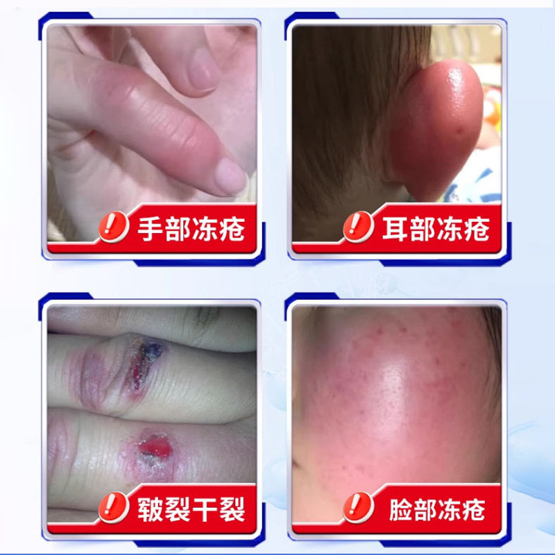 冻疮膏防冻伤涂抹霜防裂滋润皮肤修护霜冬季皮肤保湿霜红花冻疮膏|undefined