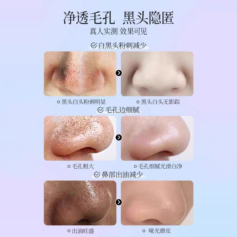 黑头导出液深层清洁面部温和不刺激去粉刺闭口收缩毛孔温和去黑头|undefined