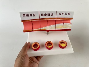 Vascular blocking arterial atherosclerosis cardiovascular arteriosclerosis mold vascular pathological model thrombosis