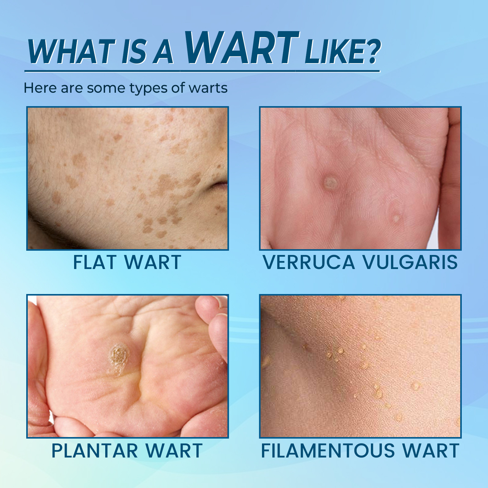 EELHOE Elimineringsplåster för hud Black Memory Curt, Chicken Eyes, Scorpions, Scarless Nevus Cocoon Cleaning and Repair_voghion.com