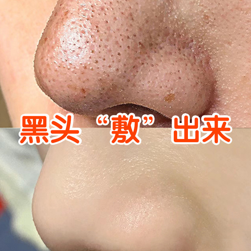 美容院専用の黒頭導出液は口を閉じてにきびをして毛穴を収縮します。|undefined