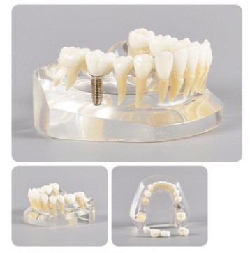 Modelo de ortodoncia dental semi-metal semibrackets Práctica de corrección de molde dental estándar Comunicación médico-paciente Modelo de enseñanza Modelo dental