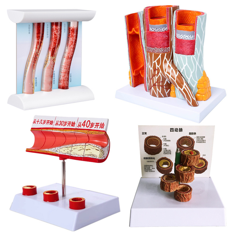 Simulated Dynamic Vascular Model Viscosity Blockage Flow Contrast Plaque Thrombosis Hardening Human Body Display Teaching Simulated Dynamic Vascular Model Viscosity Blockage Flow Contrast Plaque Thrombosis Hardening Human Body Display Teaching