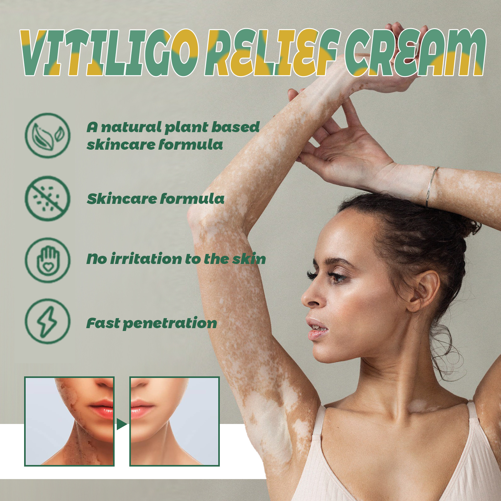 South Moon Vitiligo Soothing Cream Vitiligo Ointment Repair Vitiligo Spotted Skin External Care Ointment_voghion.com