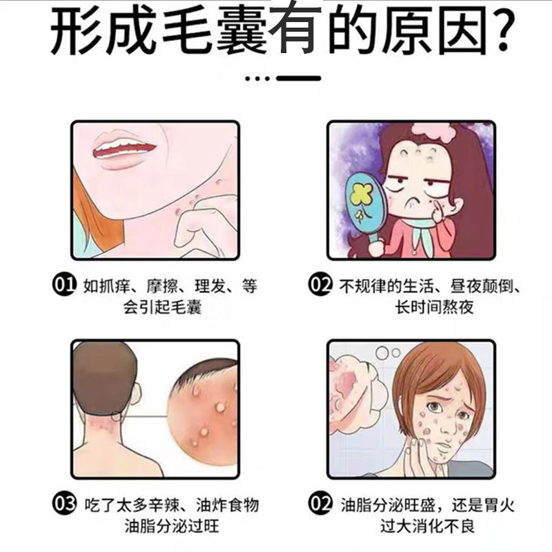 毛包清スプレーの背中の頭の上の角質のしこりの毛穴の清潔なかゆみ止めの60ml/本の現物|undefined