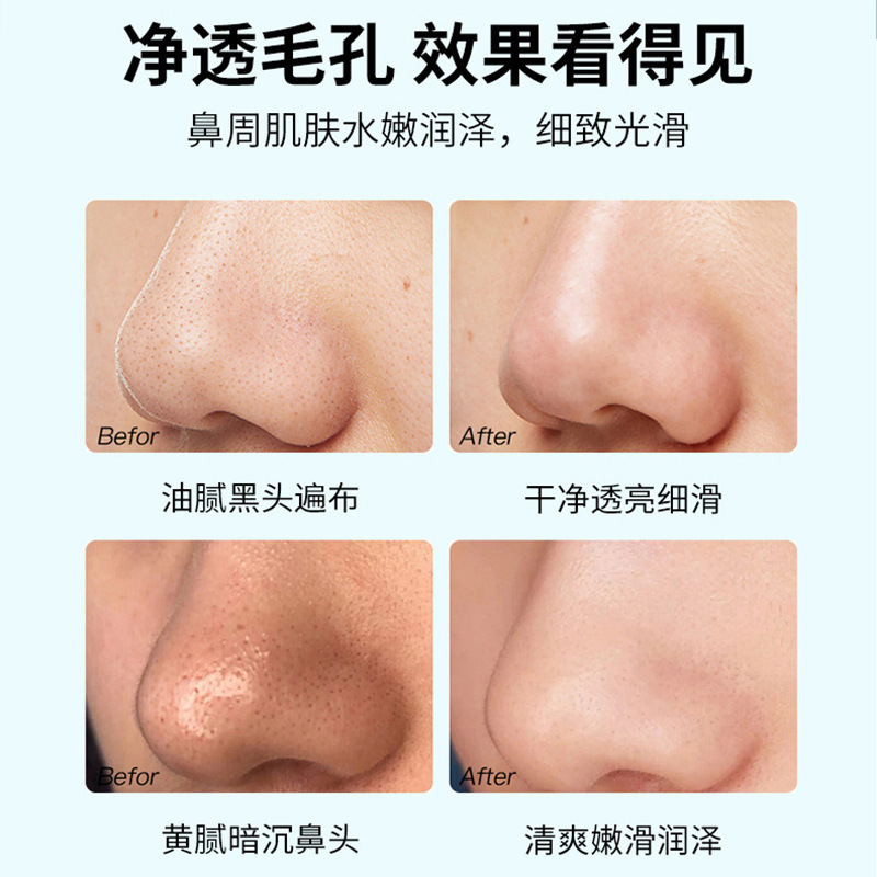 Blackhead removal nasal Mask Patch Black and White Head Extractor Pore Shrinking Essence Gentle and non-irritating deep clean pores