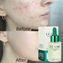 羳רsalicylic acid acne removal serumˮҺOBM