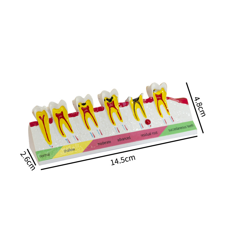 Modelo de clasificación de caries dental Demostración de la evolución de la caries dental Explicación de la comunicación médico-paciente Modelo de enseñanza dental oral