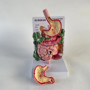 Large intestine pathological model large intestine model Gastrointestinal lesions anatomical model intestinal diseases human colon disease model