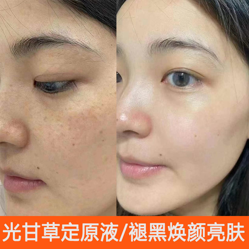 光甘草定原液は色素を分解し、肌の色を明るくし、抗酸化作用があり、黄褐色の色素を薄くする高濃度エッセンスです。|undefined