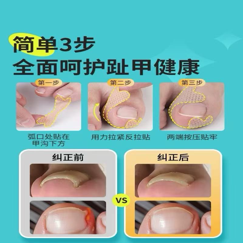 蝴蝶型正甲贴甲沟指甲矫正贴脚趾甲纠正贴免胶水拉拉贴防嵌甲贴炎|undefined