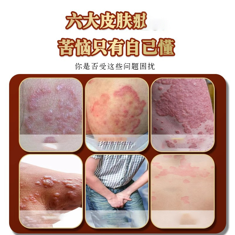 湿気を抑え、かゆみを和らげる、脚の皮膚、陰嚢の痒み、乾癬、股部の湿疹、頑固な皮膚炎、汗疱、発疹の治療に効果的な軟膏、保湿スキンケア|undefined