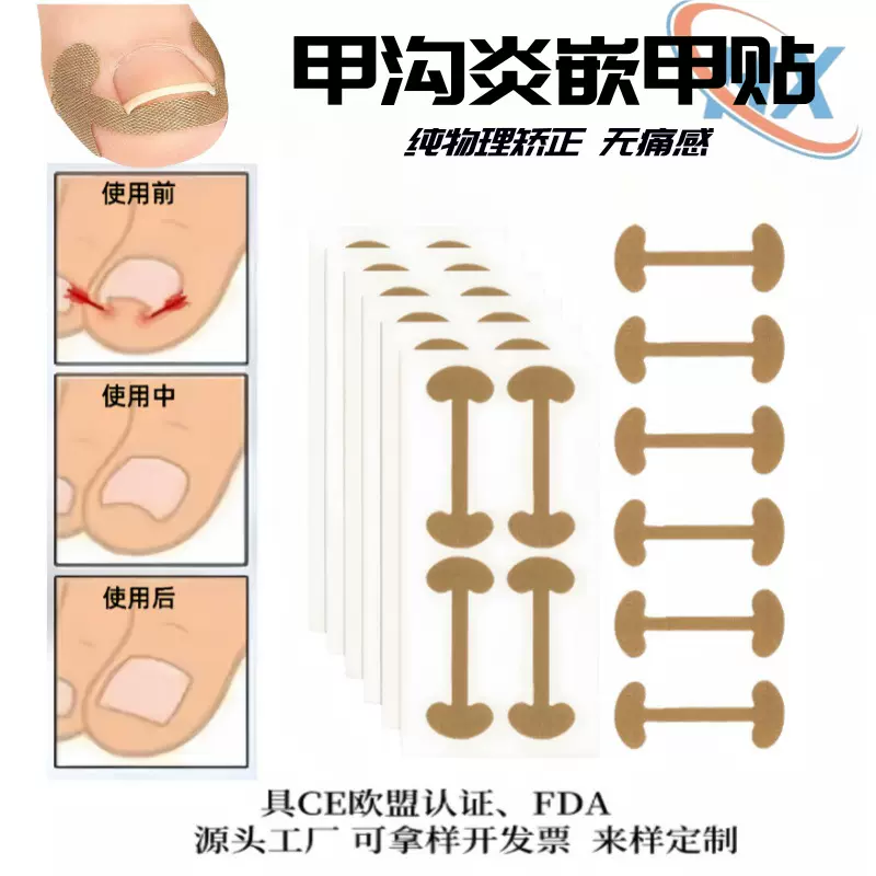 免胶水正甲贴脚趾甲往肉里长甲沟嵌专用隔离骨头形指甲矫正纠正贴