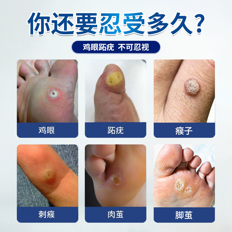 Lijun 鶏目パッチ、鶏目石膏、肉いぼ、角質、厚いキューティクル、フットケア、足裏、足|undefined