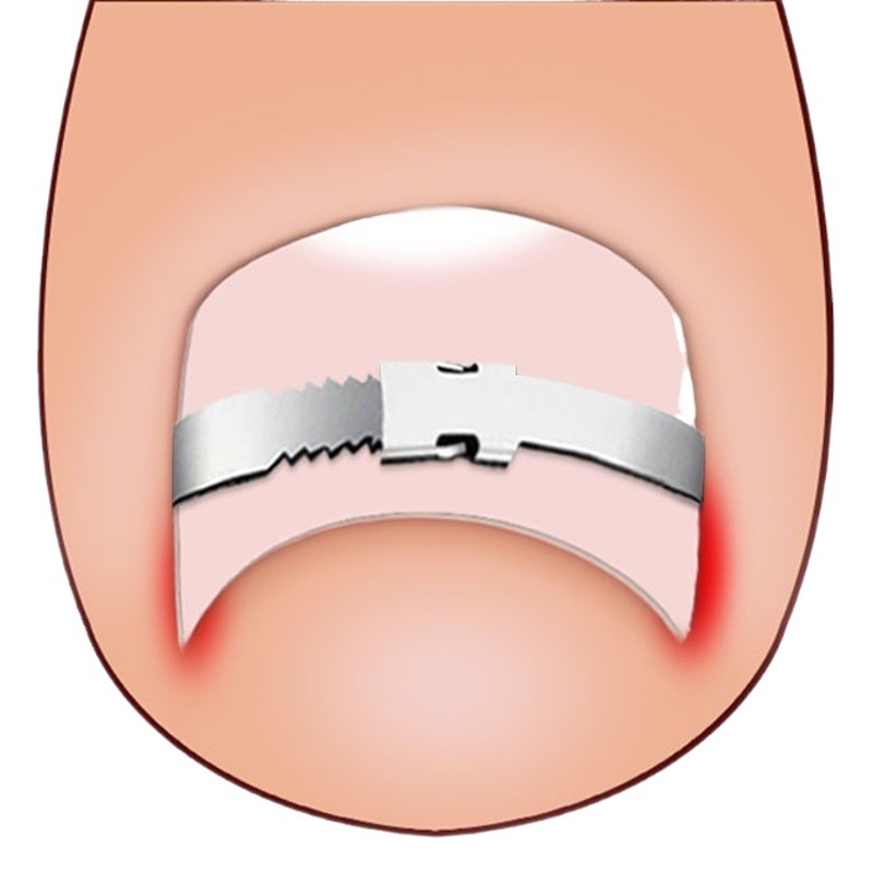 Nail button nail nail pricking lala patch toenails into the meat long pricking flesh correction nail correction appliance inflammation