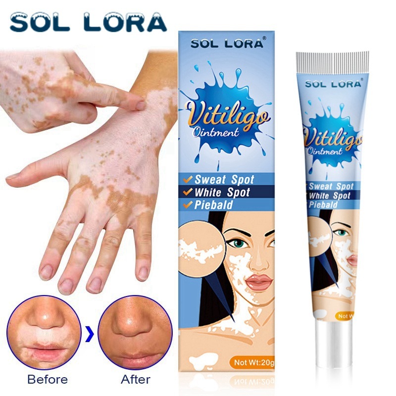 Sol lora白斑クリーム汗斑白斑花斑皮膚外用クリーム国境を越えたアマゾンwish速売通|undefined