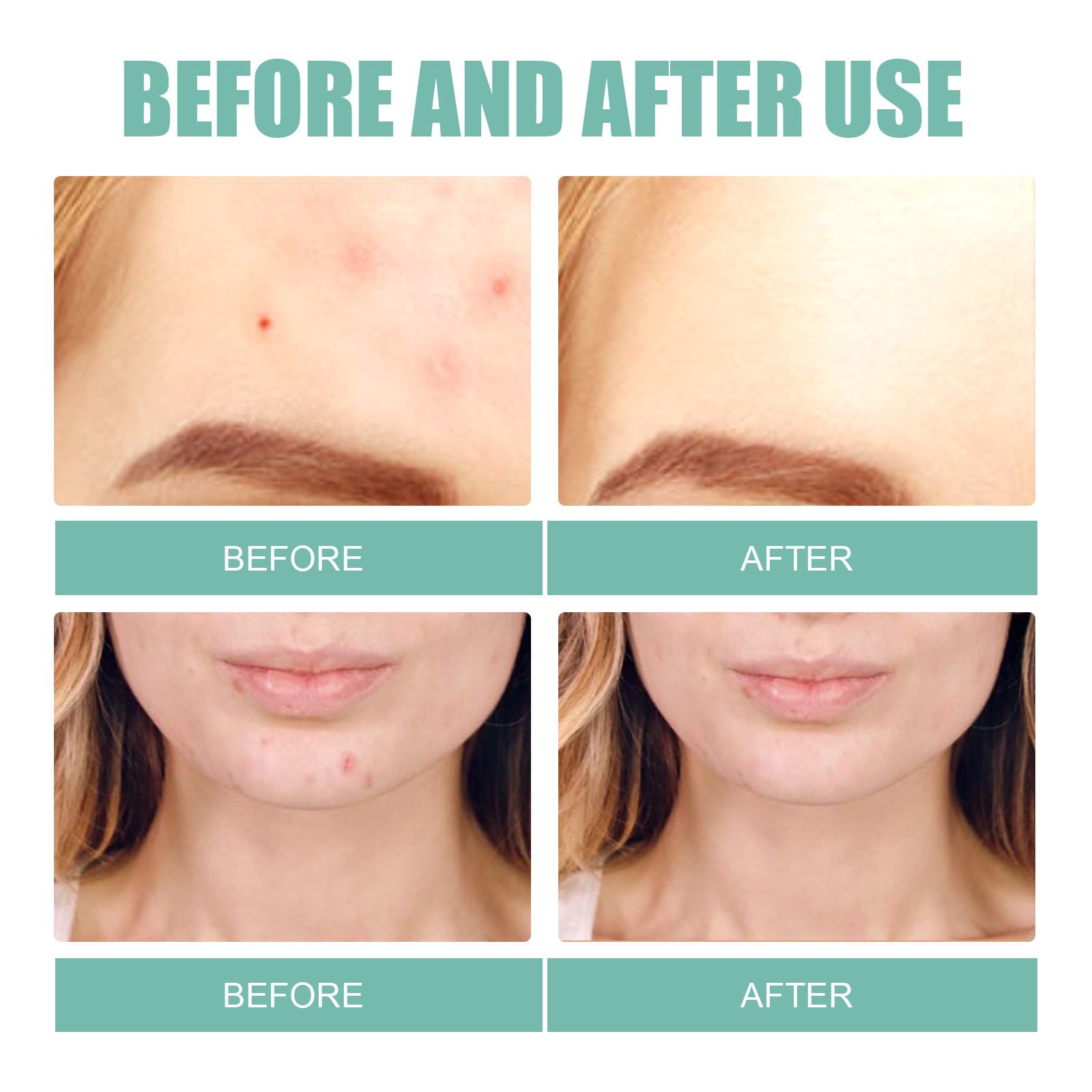 EELHOE Removing facial mask Mild and Non irritating Lighten Marks Healing Acne Repair Patch_voghion.com