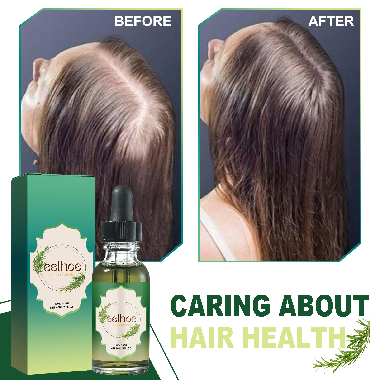Das ätherische Rosmarin-Haaröl von EELHOE pflegt die Kopfhaut, beugt Haarausfall vor, verdichtet, spendet Feuchtigkeit und stärkt die Haarpflege_voghion.com