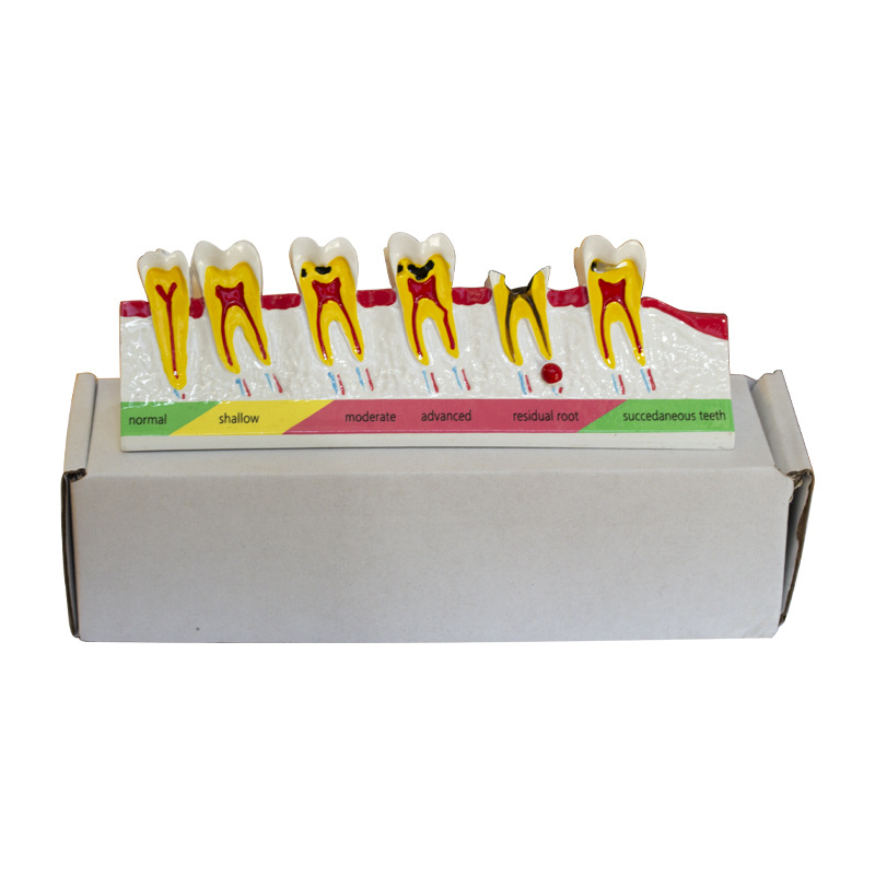 Modelo dental, modelo de enseñanza oral para la clasificación de caries, modelo didáctico, modelo dental