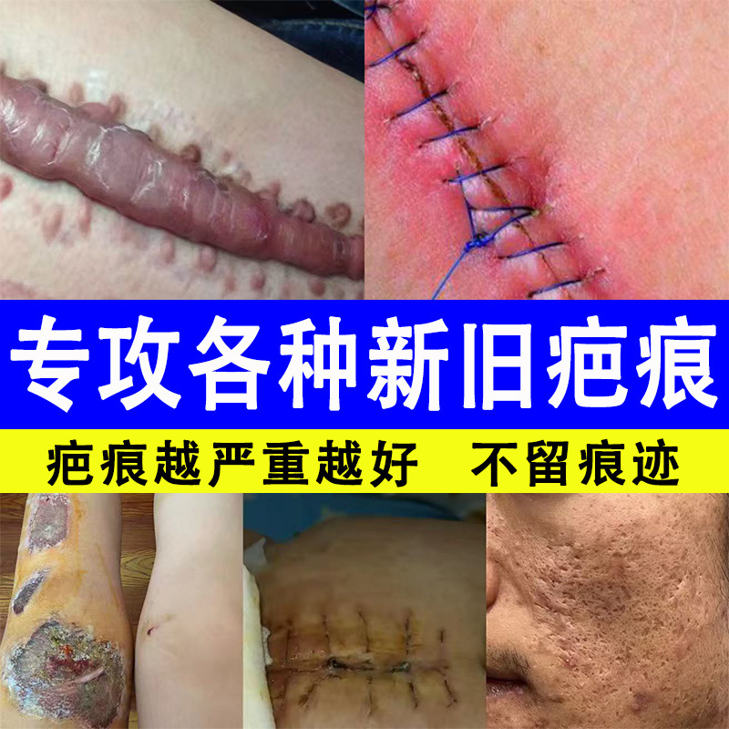 Scar Repair Cream, Scar Removal Cream, Post-Scald Post-Operative Postpartum Scar Hyperplasia Scar Repair, Whole Body Beauty Salon Scar Cream
