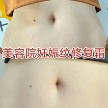 妊娠纹修复霜产后祛孕纹预防肥胖纹生长纹紧致收腹去妊辰纹特卖