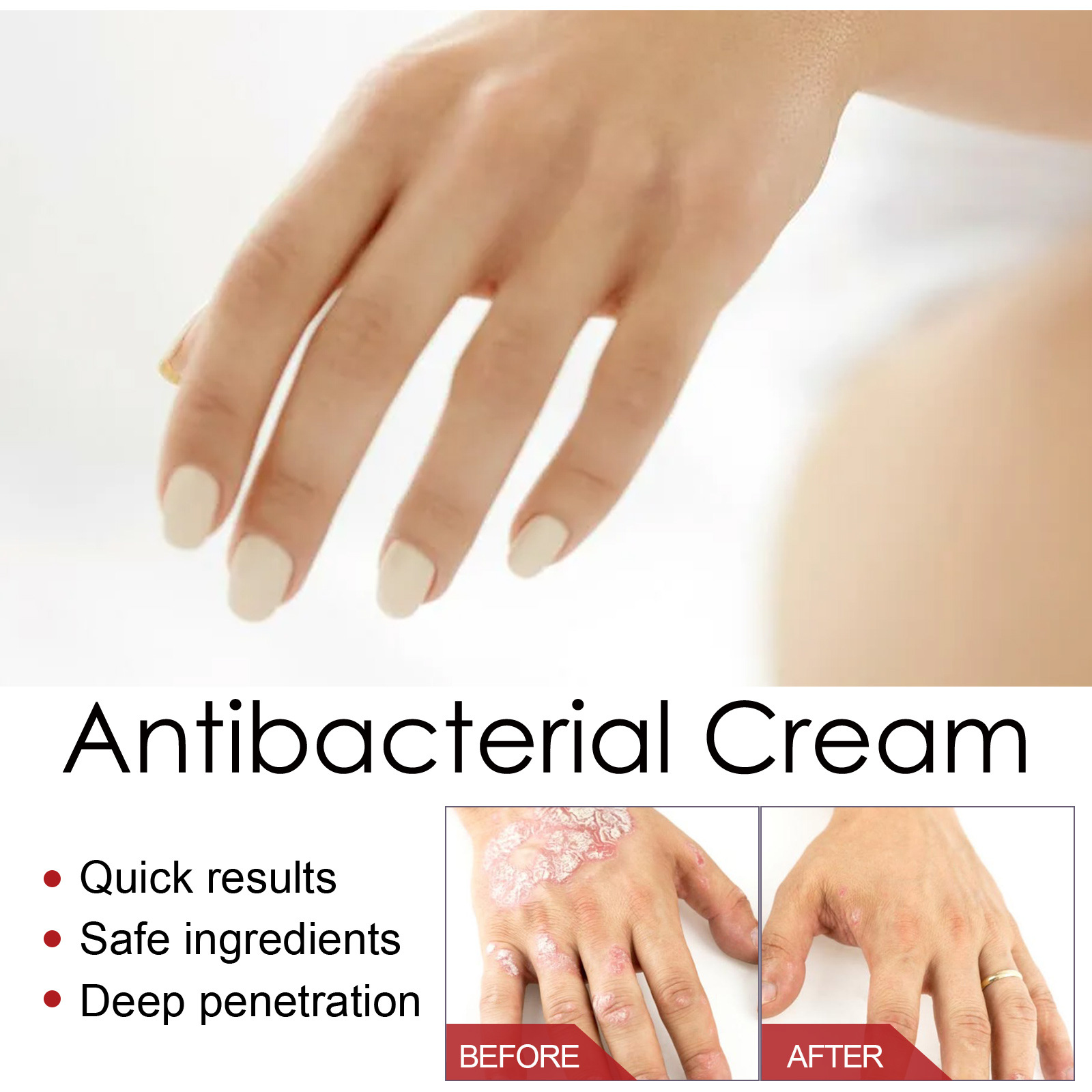 South Moon Psoriasis Care Cream Zarudnutí pokožky těla, svědění, krém proti svědění a lupénce na rukou a nohou_voghion.com